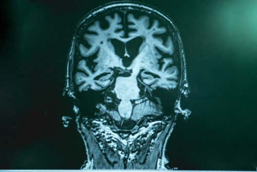Cerebro con enfermedad de Alzhéimer