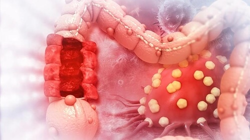 Cáncer de colon