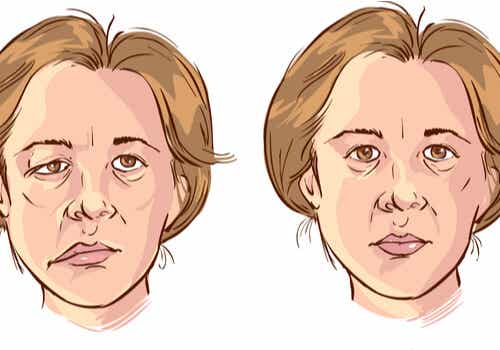 Parálisis facial en una mujer