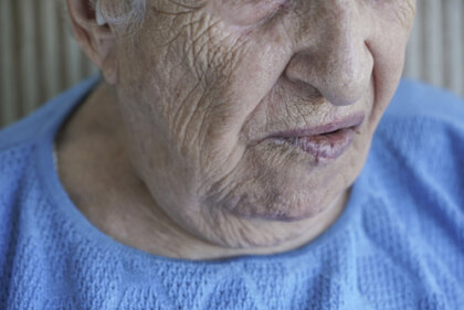 Parálisis facial: cuando el rostro no responde