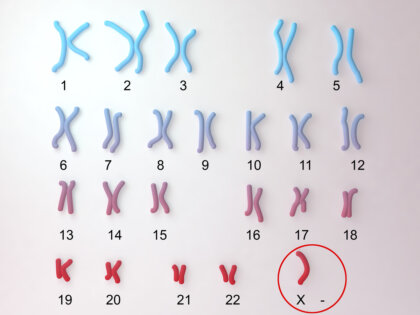 Síndrome de Turner, la monosomía X