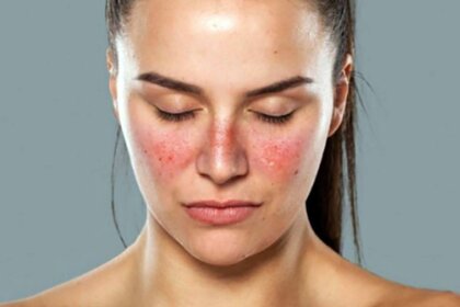 El lupus y la depresión ¿cómo se relacionan?