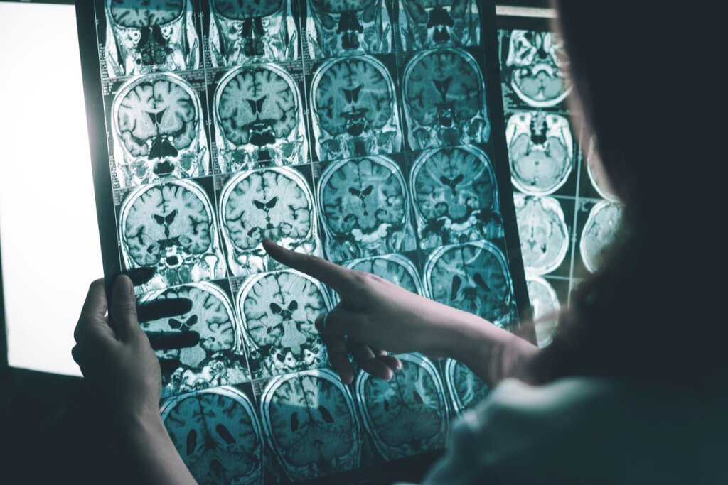 Ondas gamma contra la enfermedad de Alzheimer
