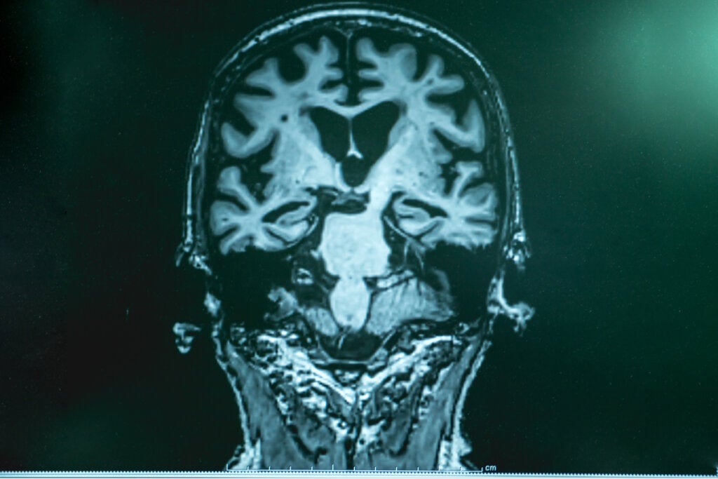 Cerebro de una persona con alzheimer por resonancia magnética