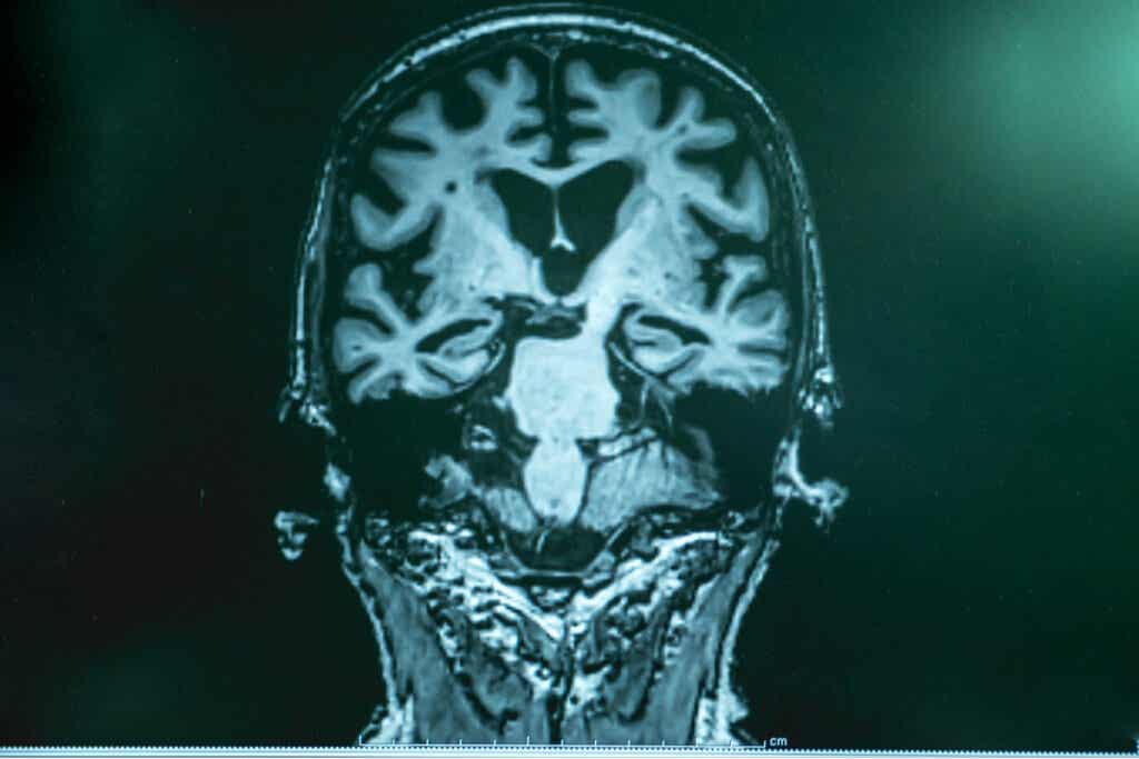 Cerebro de una persona con alzheimer por resonancia magnética