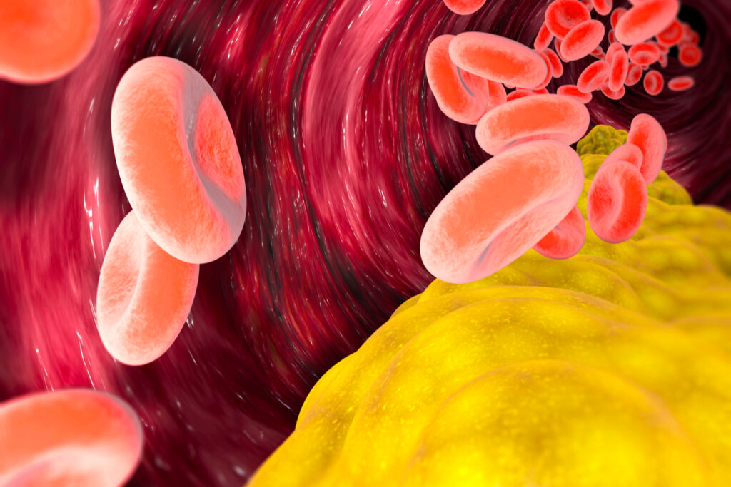 Colesterol en arteria