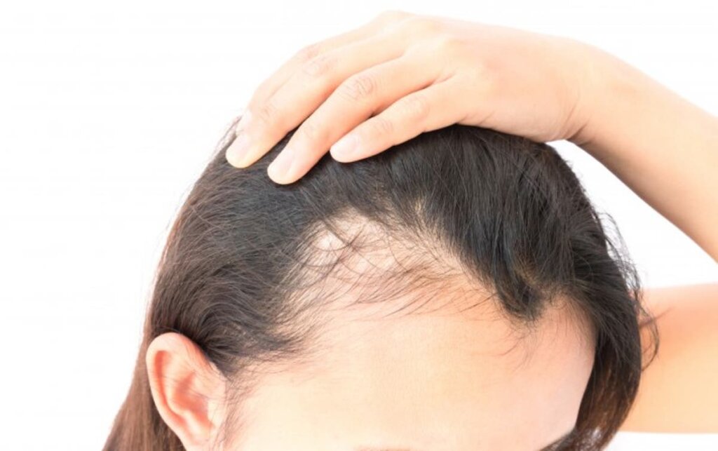 Chica que sufre pérdida de cabello por ansiedad