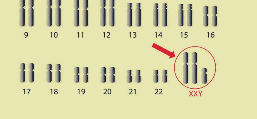 Cromosomas representando el l síndrome de Klinefelfer