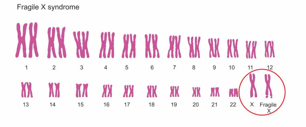 Cromosomas del síndrome X frágil