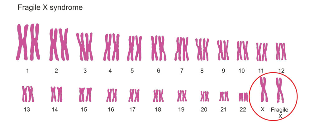 Cromosomas del síndrome X frágil
