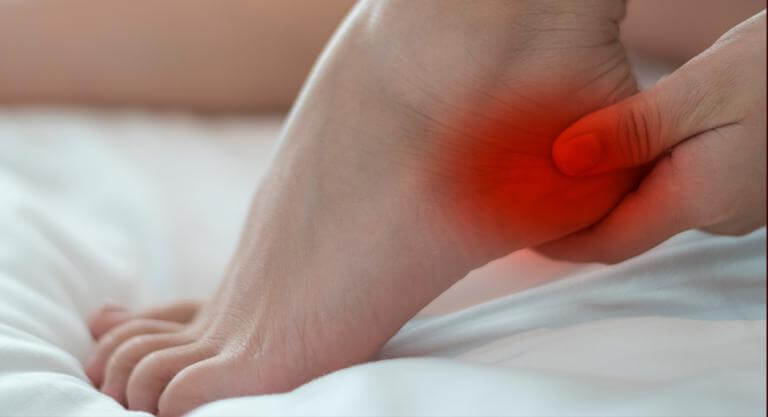 Talón enrojecido debido al síndrome de los pies ardientes