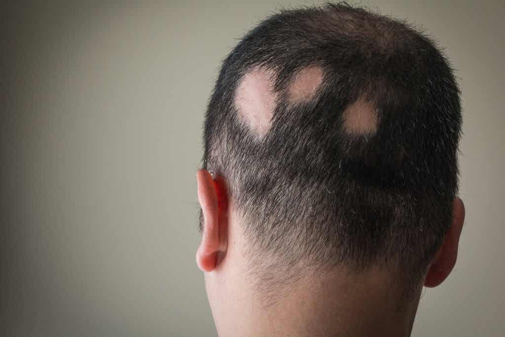 Hombre con alopecia nerviosa