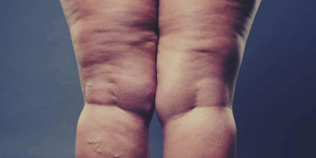 legs of woman with lipidema