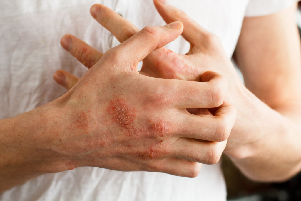 ¿Qué es la neurodermatitis?