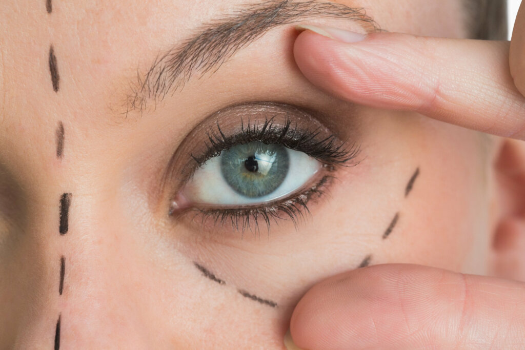 Ojo de mujer con marcas por cirugía estética