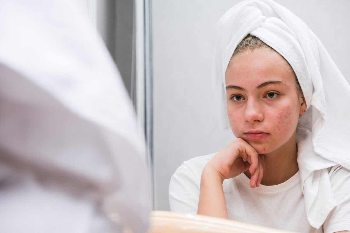 El impacto psicológico del acné en la adolescencia