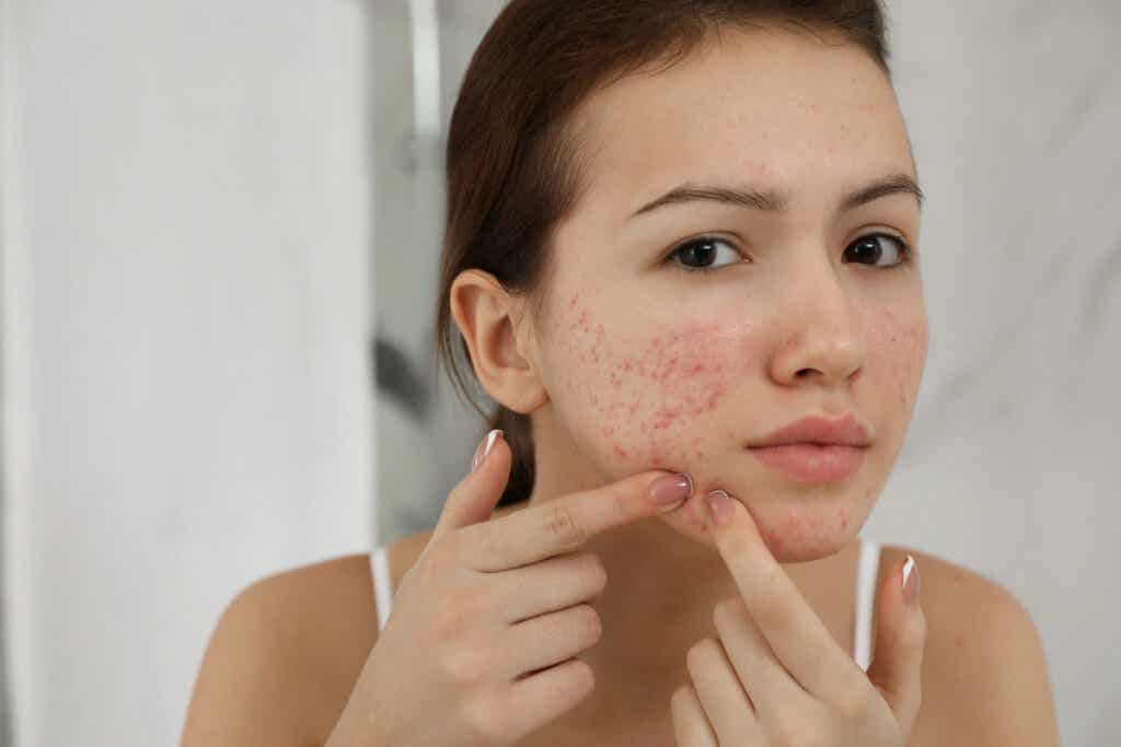 Girl looking at pimples