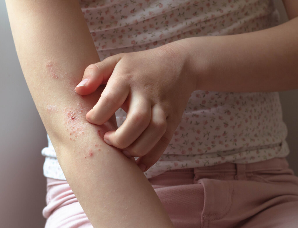 Girl scratching her arm