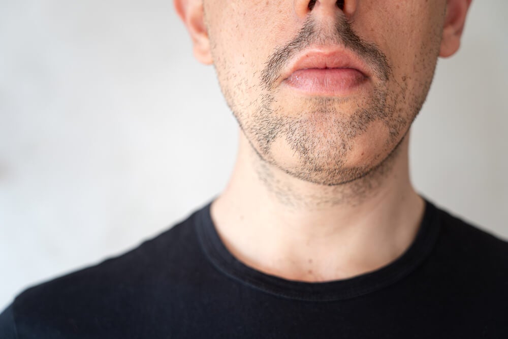 Alopecia areata in de baard