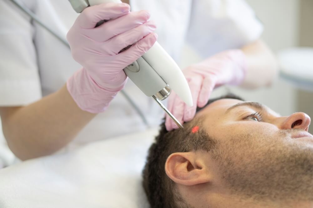 behandling av alopeci