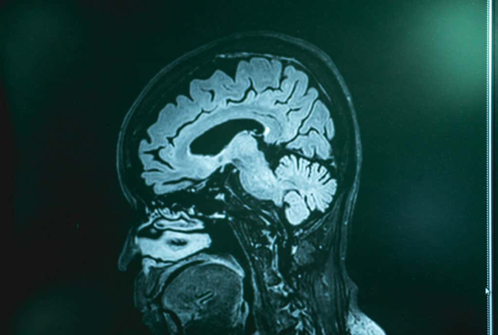 Frontotemporal demens MR-skanning, selv om det har vært årsaken til Nietzches galskap