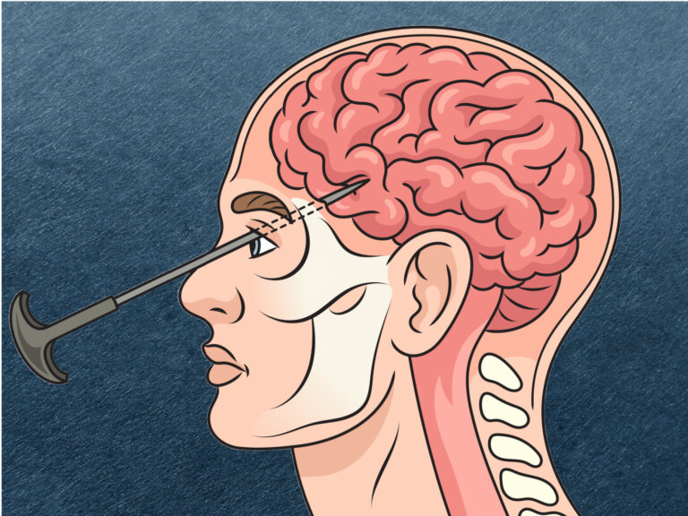 ¿Qué es la lobotomía y para qué se practicaba?